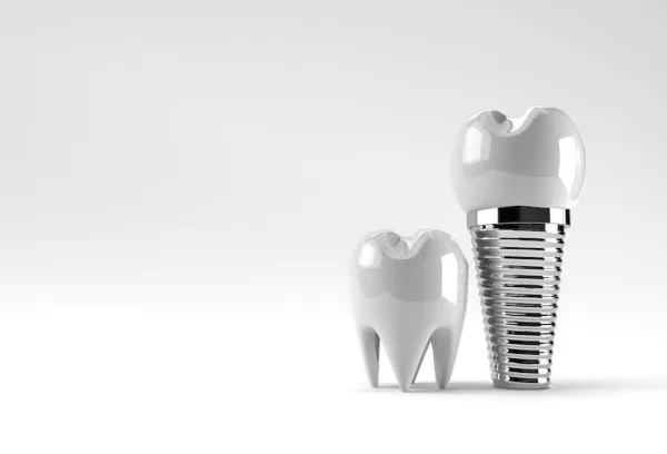 Implantes Dentários